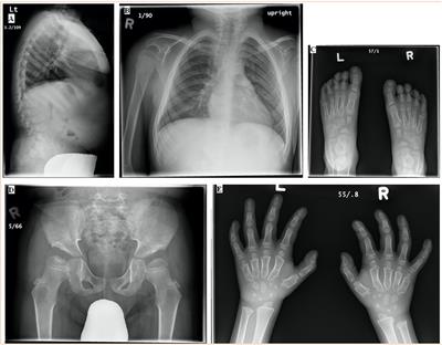 Morquio B disease: a case report